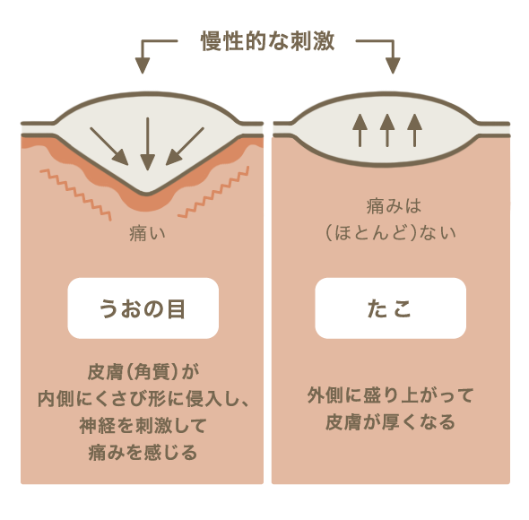 うおの目とたこの刺激図