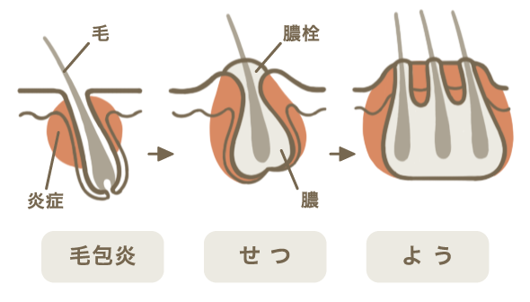 毛包炎 毛嚢炎 皮膚症状一覧 ひふ研 ひふ症状 ひふ薬の使い方の疑問に答える情報サイト 第一三共ヘルスケア