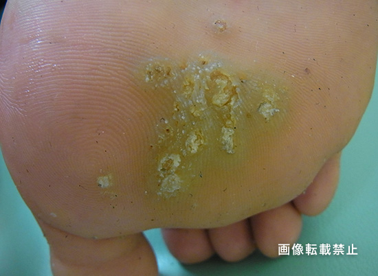 皮膚画像検索 ひふ研 ひふ症状 ひふ薬の使い方の疑問に答える情報サイト 第一三共ヘルスケア