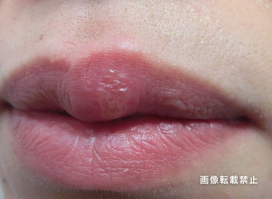 腫れ 画像 唇 口唇ヘルペスなのか画像でチェックすればある程度は判断ができます