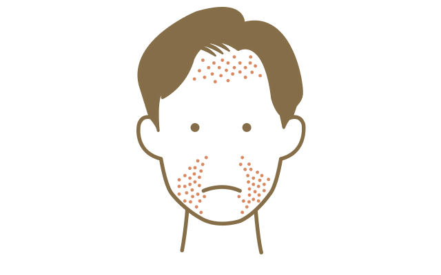脂漏性皮膚炎を発症している男性のイラスト