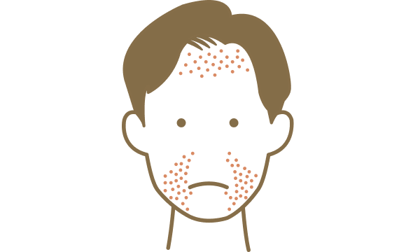 脂漏性皮膚炎を発症している男性のイラスト