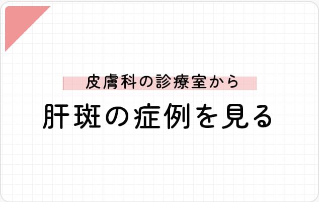 皮膚科の診察室から－肝斑の症例を見る－