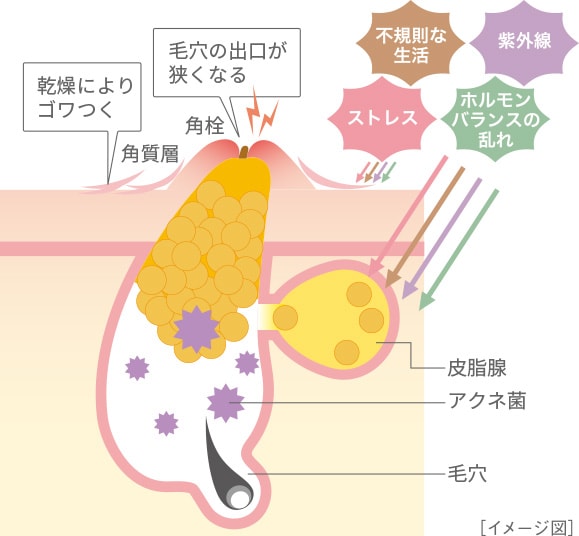 大人ニキビの原因とは イメージ