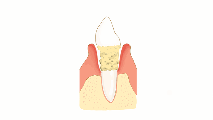 中度歯周炎