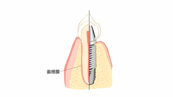 なぜインプラントも歯周病になるの？
