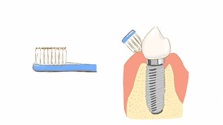インプラント歯周炎を防ぐために