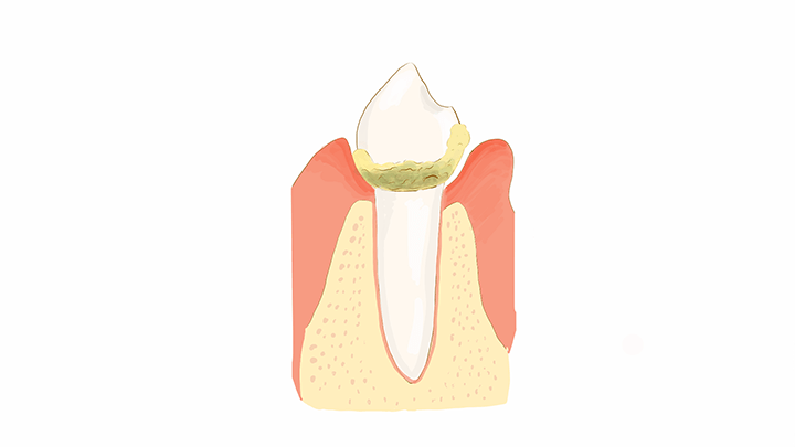 歯石の付着