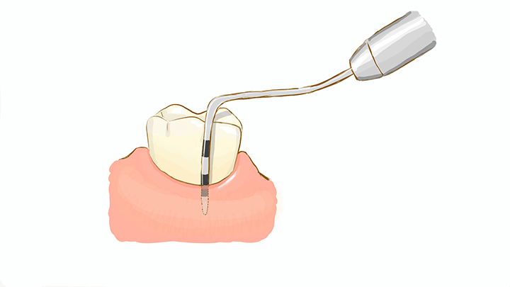 歯周ポケットの検査