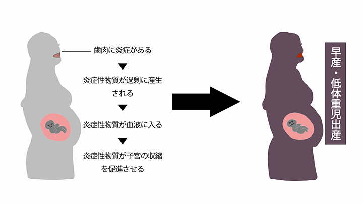 歯周病と低体重児出産～歯周病菌が子宮を襲う～