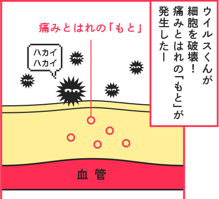 ウイルスくんが細胞を破壊！痛みとはれの「もと」が発生した！